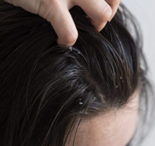 close-up-woman-with-dandruff-issues