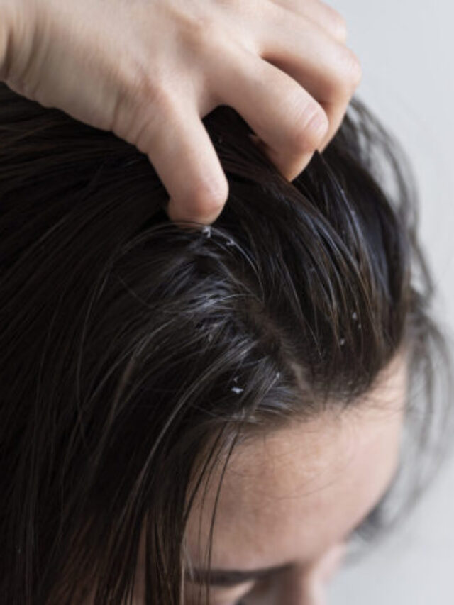 6 Major Causes Of Dandruff